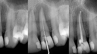 X-rays of root canal treated teeth