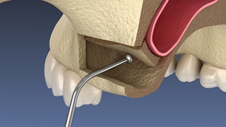 Illustration of instrument being used to push sinus membrane upward