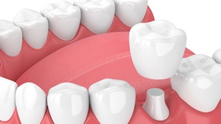 Illustration of dental crown being placed on prepared tooth