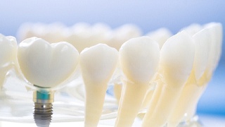Model showing how dental implants in Lakeville work
