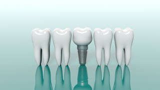 Single tooth dental implant in Lakeville lined up with model teeth for comparison