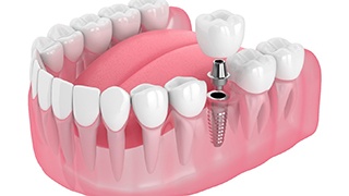 Illustration of dental implant, abutment, and crown in lower arch