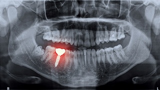 Highlighted X-ray of a failing dental implant in Lakeville