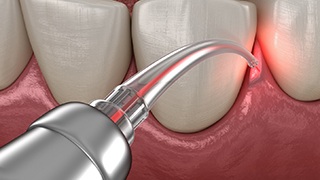 Illustration of laser being used during periodontal treatment