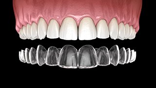 Illustration of clear aligner being placed on teeth