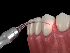 laser dentistry being used for gum treatment during COVID-19