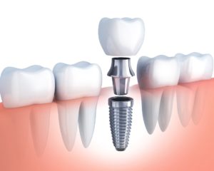 dental implant illustration